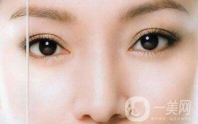 長(zhǎng)沙割雙眼皮費(fèi)用是多少？?jī)r(jià)格盤點(diǎn)