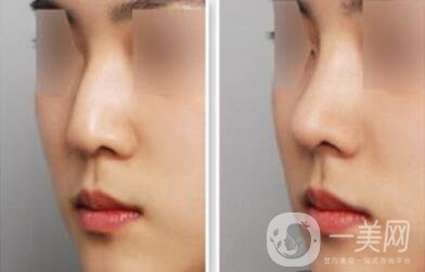 杭州駝峰鼻矯正多少錢 駝峰鼻手術(shù)價(jià)格