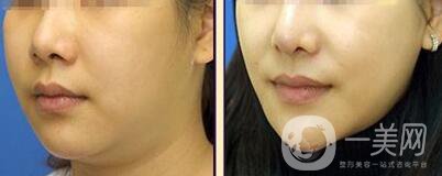 等離子激光溶脂價(jià)格、大概需要多少錢