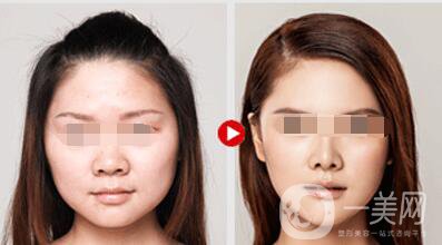 等離子激光溶脂價(jià)格、大概需要多少錢