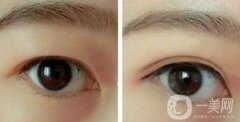 韓式三點雙眼皮的缺點詳細介紹 手術前后圖