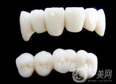 烤瓷牙能用多長時(shí)間？烤瓷牙的壽命有多長
