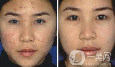 像素激光去痘多久才會好 祛痘對*果