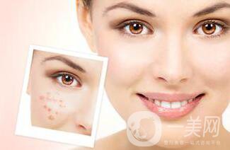 像素激光去痘多久才會好 祛痘對*果