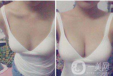 妙桃假體豐胸,多少錢