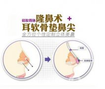 北京耳軟骨墊鼻尖價格 北京耳軟骨墊鼻尖多少錢