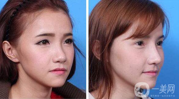 北京,耳軟骨墊鼻尖,價格