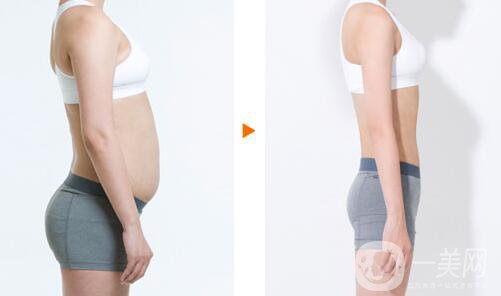 上海360度吸脂多少錢(qián) 360度吸脂價(jià)格詳解