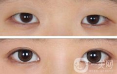 開眼角哪果好  開眼角哪家醫(yī)院比較好