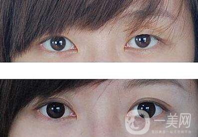 開眼角哪*果好  開眼角哪家醫(yī)院比較好