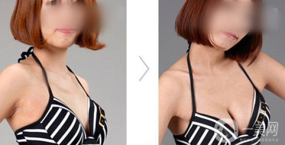 豐胸手術(shù)后注意什么 注意事項一覽