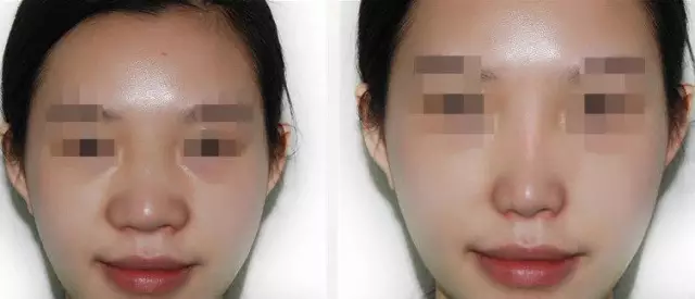 鼻翼縮小價(jià)錢(qián) 參考價(jià)格詳情