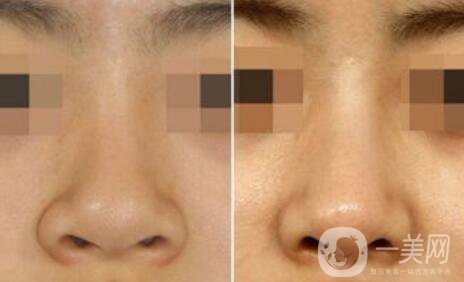 深圳鼻翼縮小多少錢能做 鼻翼縮小手術(shù)價(jià)格詳解