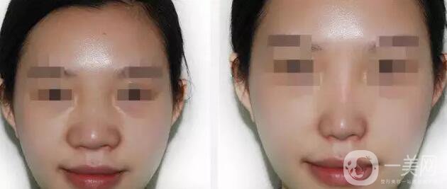 深圳鼻翼縮小多少錢能做 鼻翼縮小手術(shù)價(jià)格詳解