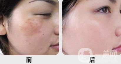 黃褐斑怎么形成的 怎么去除？