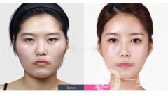 雙眼皮眼部提肌的危害有哪些？