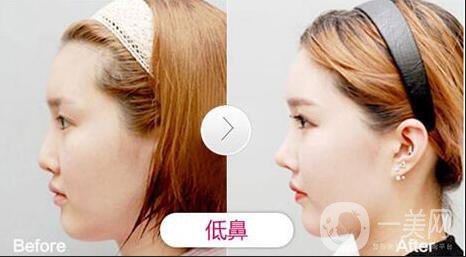 *術(shù)后1-7天的反應(yīng) *術(shù)后怎么護理