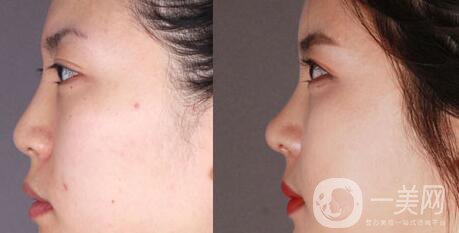 *術(shù)后1-7天的反應(yīng) *術(shù)后怎么護理