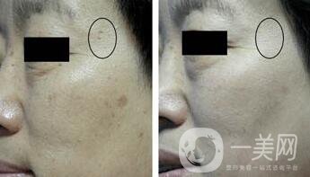 出現(xiàn)老年斑怎么辦 去掉老年斑的方法介紹
