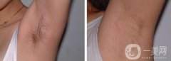 激光脫毛大概多少錢 激光脫毛具體價格