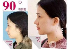 鼻子矯正費用 歪鼻矯正多少錢