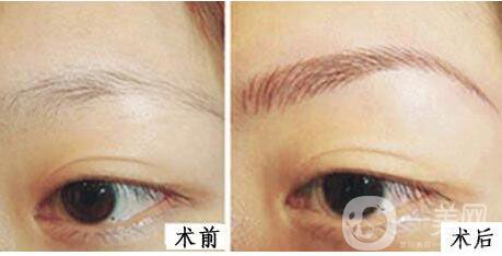 上海,假體豐眉弓,價格