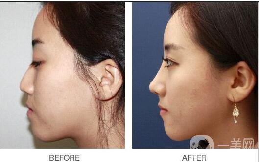 深圳,微整形,鼻子,價(jià)格