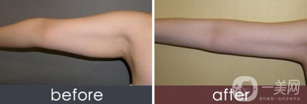 上臂吸脂多久看到*果 適用于哪些人群？