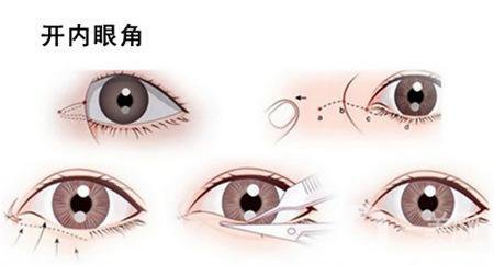 什么人適合開眼角 開眼角適宜人群