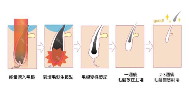 做一次激光脫毛的價格大概要多少錢？