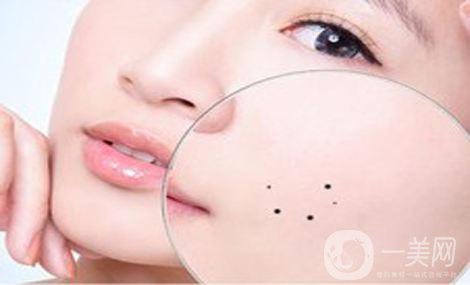 去痣多少錢 祛痣價位詳情一覽