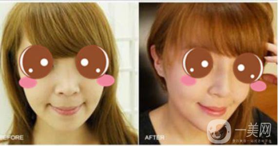 膨體聚四氟乙烯隆鼻*果怎么樣？