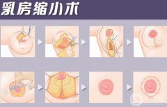巨乳縮小疤痕嚴重怎么辦 巨乳縮小后祛疤方法