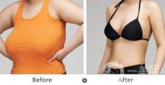 巨乳縮小術疤痕大嗎 巨乳縮小會留疤嗎