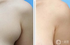 副乳吸脂幾天消腫 副乳吸脂術后多久恢復