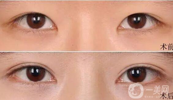 割雙眼皮,注意事項(xiàng)