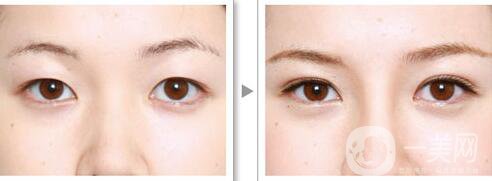 成都割雙眼皮價(jià)格是多少 做雙眼皮手術(shù)大概多少錢