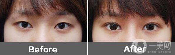 割雙眼皮整形醫(yī)院信息介紹 雙眼皮醫(yī)院如何選擇