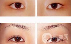 太原割雙眼皮介紹 太原做雙眼皮醫(yī)院