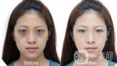 激光去黑眼圈副作用詳細介紹 去黑眼圈圖