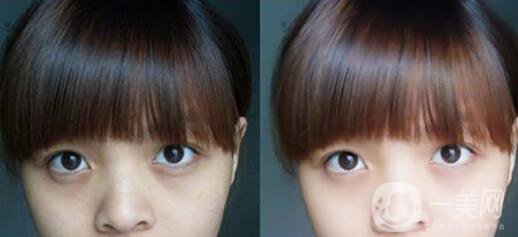 激光去黑眼圈副作用詳細介紹 去黑眼圈圖