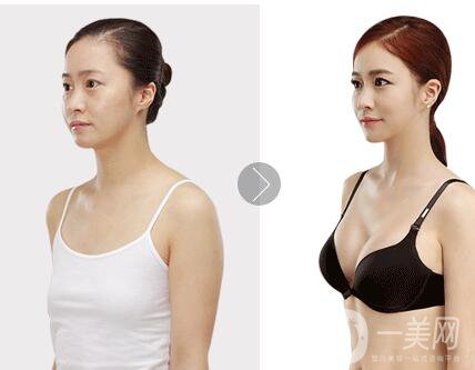 明星,隆胸,多少錢