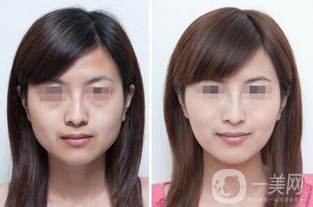 去頰脂墊*果 去頰脂墊*果與哪些因素有關(guān)