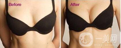 假體隆胸,注意事項(xiàng)
