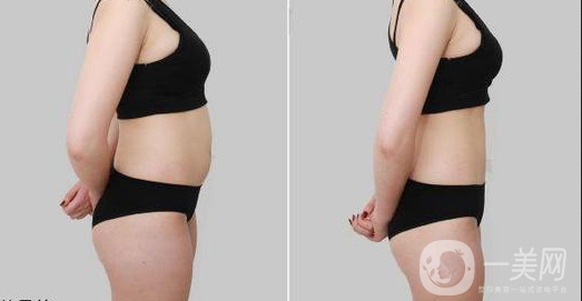 等離子激光溶脂價格 *果怎么樣？