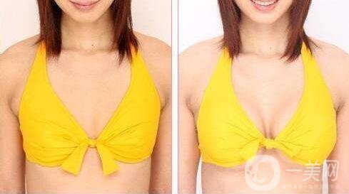 北京隆胸手術(shù)一般多少錢(qián) 價(jià)格是多少