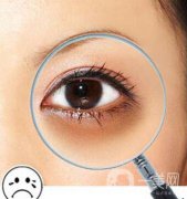 激光黑眼圈術(shù)后護(hù)理 激光去黑眼圈注意事項(xiàng)