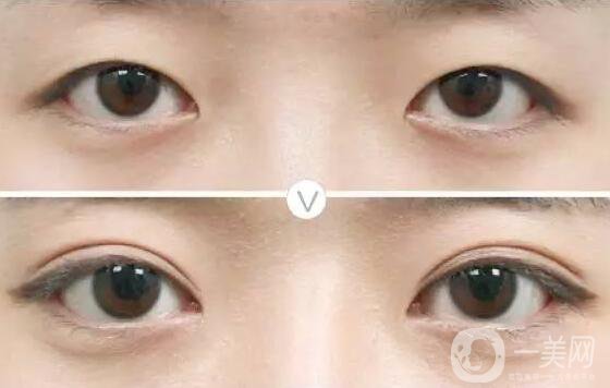 雙眼皮做失敗怎么修復 雙眼皮失敗修復