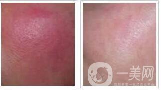 調節(jié)紅血絲,費用