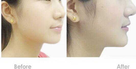墊下巴,費用
